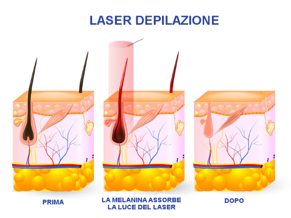 laser depilazione