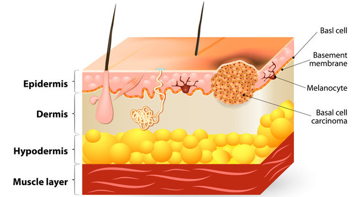 terapia-tumori-cutanei-non-melanocitari