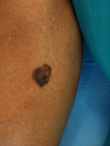 melanoma