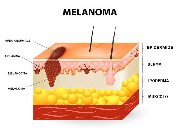 chirurgia del melanoma