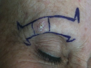 Terapia dei tumori cutanei non melanocitari