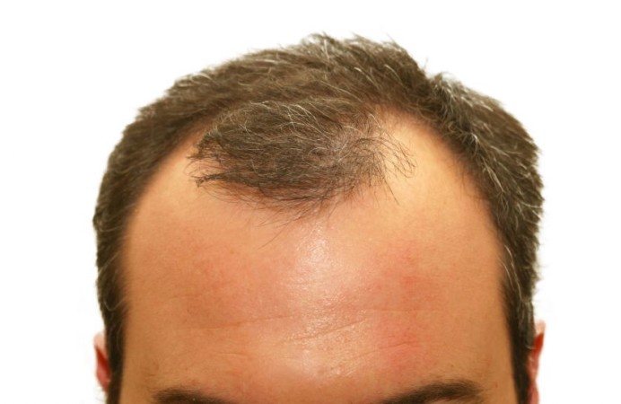 l'alopecia